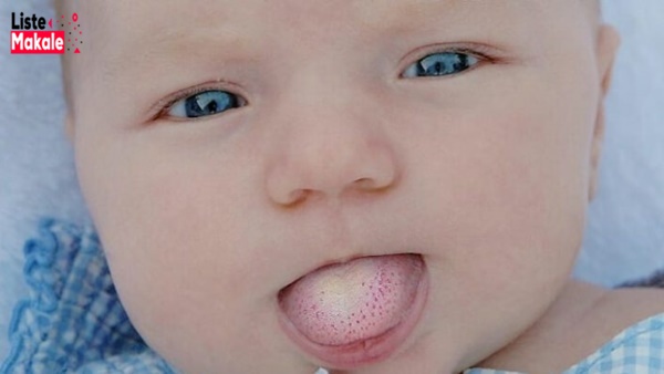 Bebeklerde Pamukçuk Neden Olur, Nasıl Geçer? 