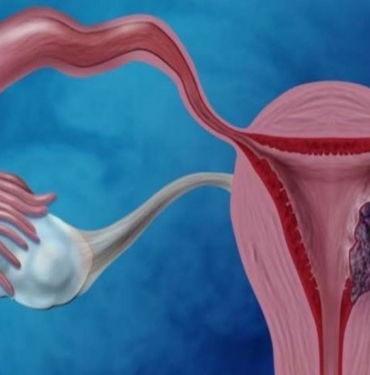 Rahim Kanseri Nedenleri, Belirtileri ve Tedavisi