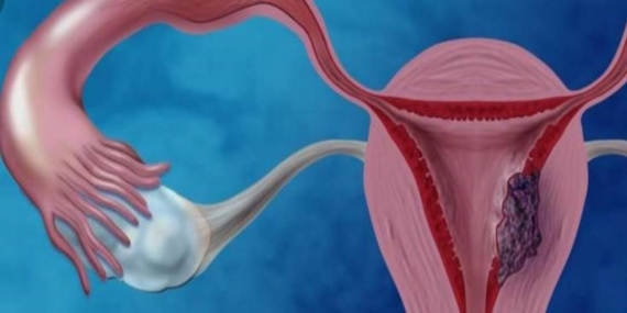 Rahim Kanseri Nedenleri, Belirtileri ve Tedavisi