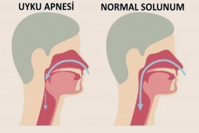 Uyku Apnesi Nedir? Uyku Apnesi Nedenleri ve Tedavisi