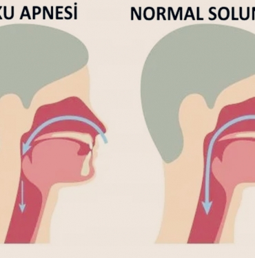 Uyku Apnesi Nedir? Uyku Apnesi Nedenleri ve Tedavisi