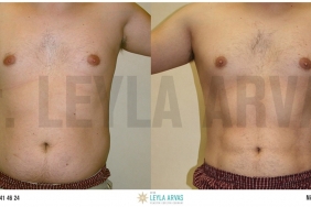 Vaser Liposuction İle Fazla Yağlara Kesin Çözüm