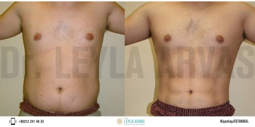 Vaser Liposuction İle Fazla Yağlara Kesin Çözüm