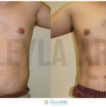 Vaser Liposuction İle Fazla Yağlara Kesin Çözüm
