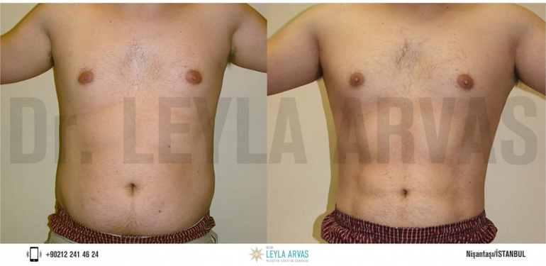 Vaser Liposuction İle Fazla Yağlara Kesin Çözüm