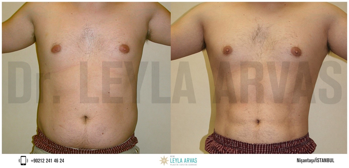 Vaser Liposuction İle Fazla Yağlara Kesin Çözüm