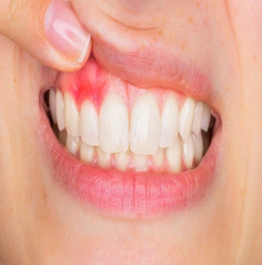 Diş Eti Şişmesi Nasıl Geçer?