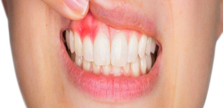 Diş Eti Şişmesi Nasıl Geçer?