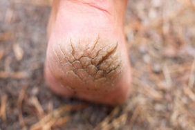 Topuk Çatlakları Nasıl İyileşir?