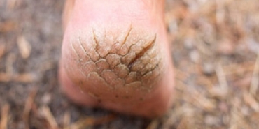 Topuk Çatlakları Nasıl İyileşir?