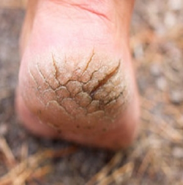 Topuk Çatlakları Nasıl İyileşir?