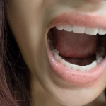 Damak Yaraları Neden Olur?  