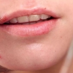 Hamilelikte Uçuk Neden Çıkar? Bebeğe Zararlı Mıdır?