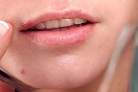 Hamilelikte Uçuk Neden Çıkar? Bebeğe Zararlı Mıdır?