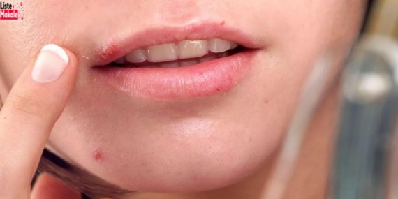 Hamilelikte Uçuk Neden Çıkar? Bebeğe Zararlı Mıdır?