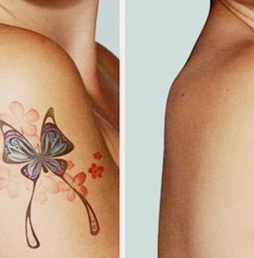 Kalıcı Dövme Sildirme Yöntemleri Nelerdir? 