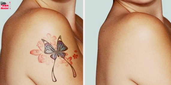 Kalıcı Dövme Sildirme Yöntemleri Nelerdir? 