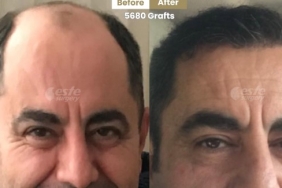 Este Surgery ile Yüksek Standartta fue