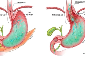 Gastrit ve Reflü Ağrılarını Saniyeler İçinde Kesen Yöntemler