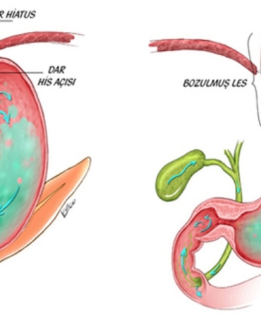 Gastrit ve Reflü Ağrılarını Saniyeler İçinde Kesen Yöntemler