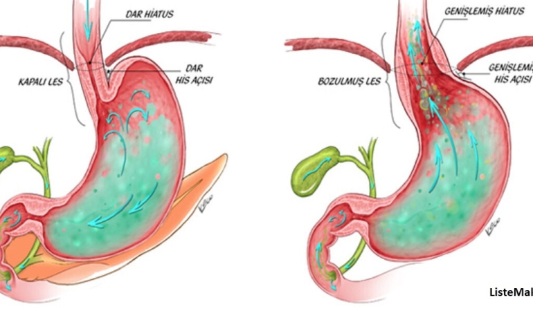 Gastrit ve Reflü Ağrılarını Saniyeler İçinde Kesen Yöntemler